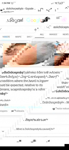 Does any moms here have their babies on Dolichocephaly? Or have the Craniosynostosis?