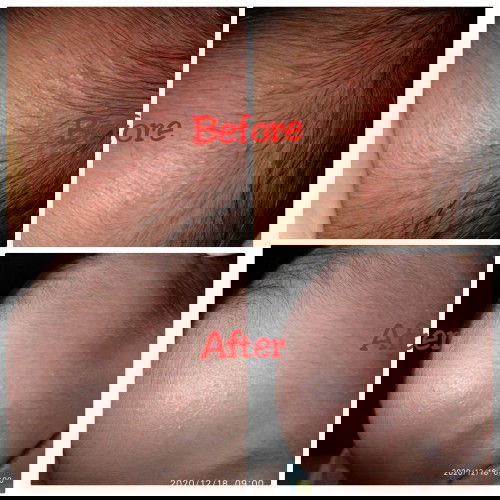 Perkembangan sebelum dan setelah memakai sabun Lactcyd Baby