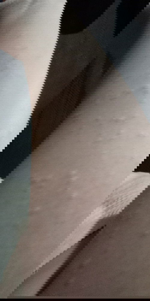 Gatal gatal seluruh tubuh