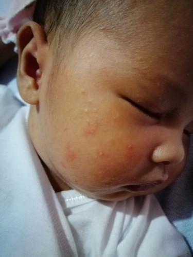 Baby acne or rashes?