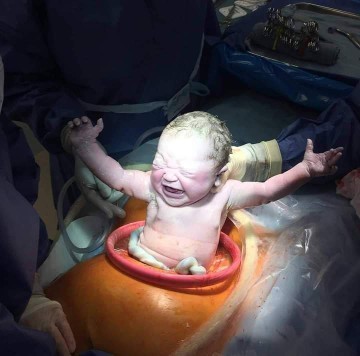 CAESAREAN SECTION