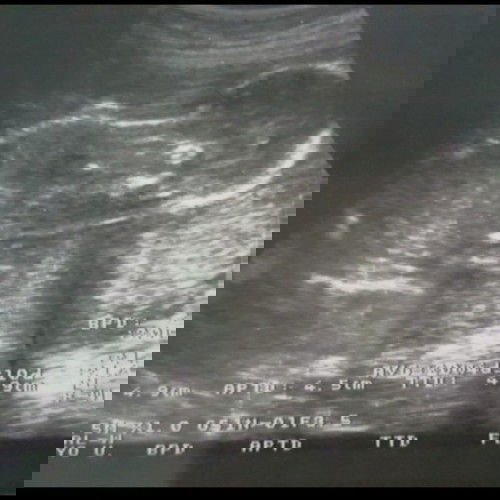 Usg 20weeks5d