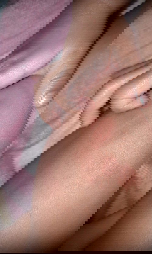 Bercak2 merah di paha