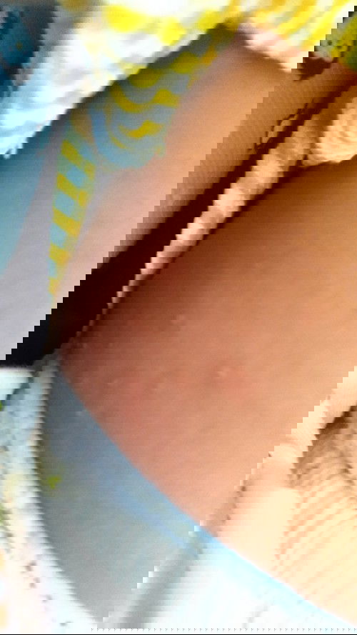 penyakit kulit pada bayi