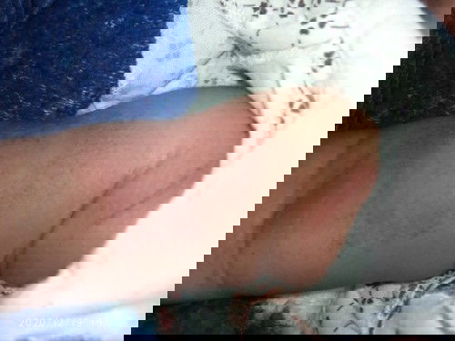 Merah merah pada bayi