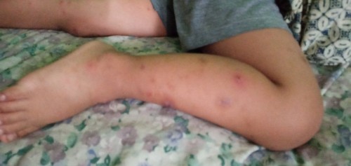 Luka borok bernanah, jika digaruk makin banyak. Apa obatnya ?