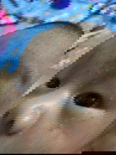 เม็ดที่หน้า