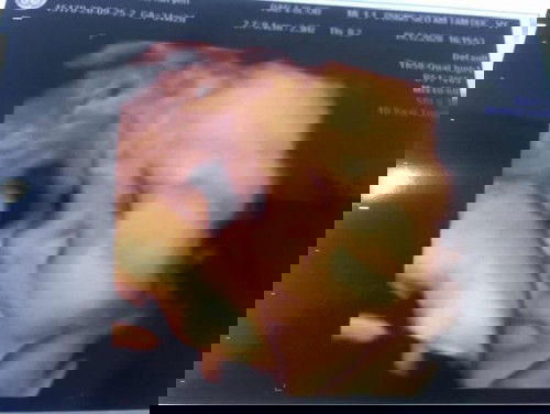 34w2d nặng 2600gram