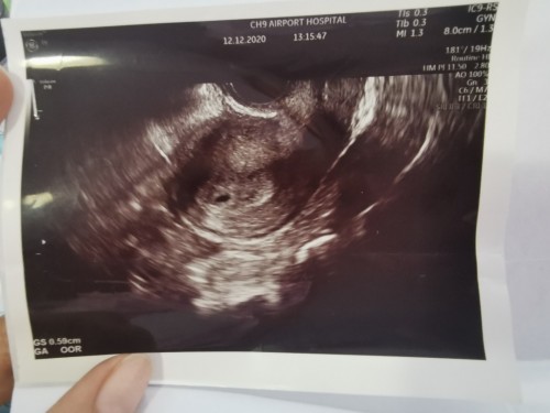 วันนี้5w+6 ปวดท้องน้อยหน่วงๆบางวัน
ไม่นานปกติไหมคะ