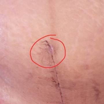 Asking advice from cesarean mommies