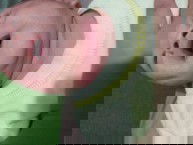 Beruntus di leher dan di muka