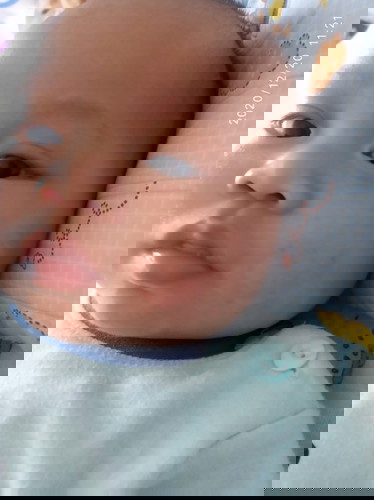 เเม่ๆคนไหนเคยมีประสบการณ์ ลูกหน้าเป็นกรากน้ำนม