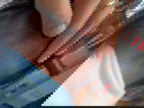 Ruam di kulit kepala