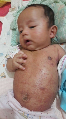 Bun baby Arsya br 2bln tp gatal2 seluruh tubuh bahkan sampe kepala jg... Ada solusi? Ato pnglmn?