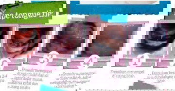 Pengalaman #IBUJUARA menyusui bayinya yang memiliki lip tie dan tongue tie