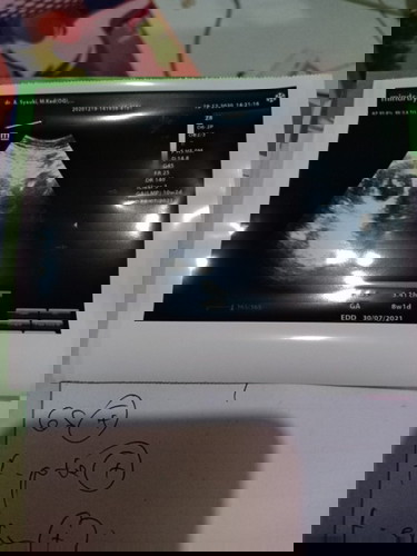 Diabetes pada ibu hamil