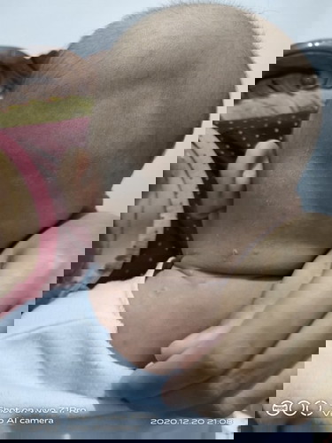 kulit memerah & mengelupas