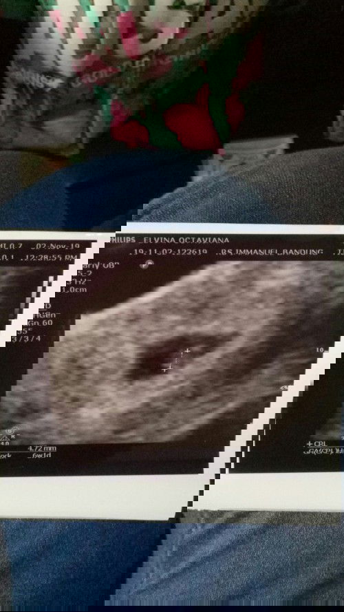 cerita kehamilan + kelahiran anakku💕 #ibujuara