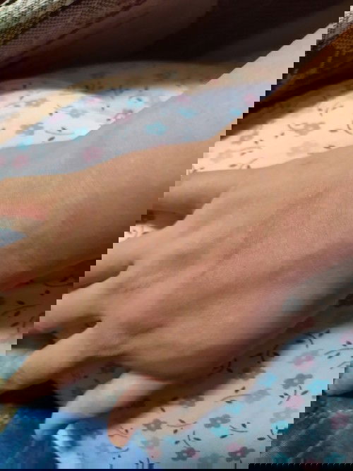 Alergi pada tangan saat hamil usia 6 bln lbh 2 mggu