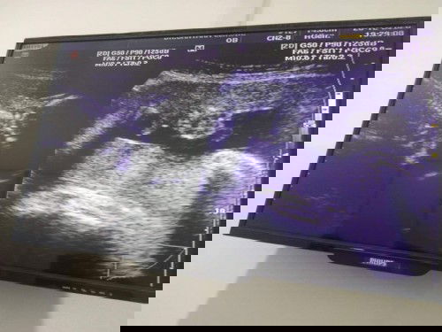 21w5d คุณหมอบอกพลิกกลับหัวแล้ว