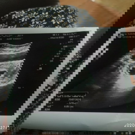 Kehamilan Pasca Keguguran