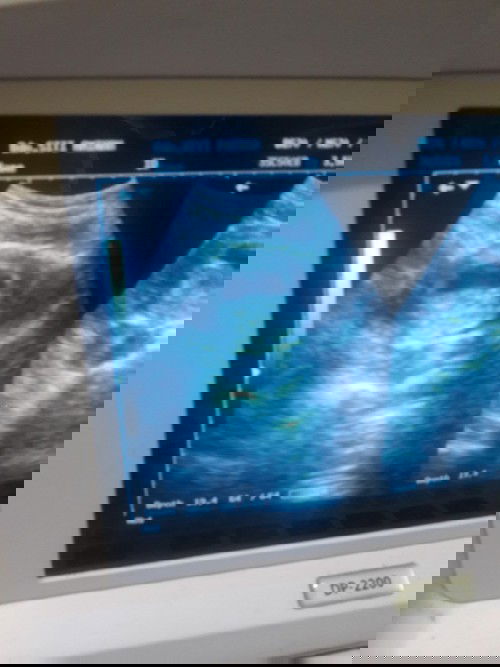 Masuk 7 minggu janin belum terlihat bagaimana ya bun ?