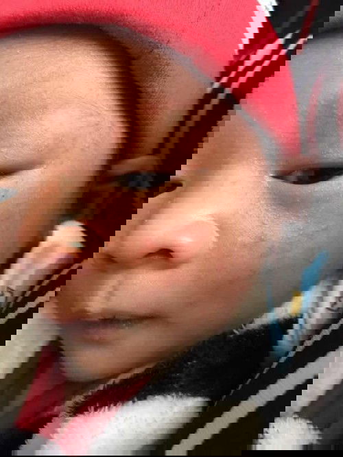 หน้าน้องเป็นผื่น ทำยังไงดีคะ