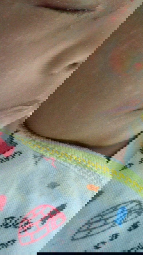 bercak putih pada bayi