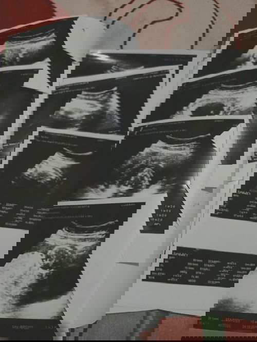 Kehamilanku yang penuh mukzijat #ibujuata