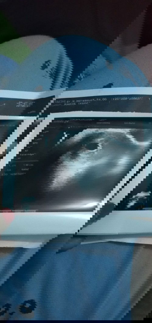 janin blm.berkembang takut di vonis BO  :((