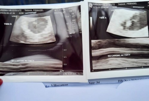 No heartbeat at 7 weeks