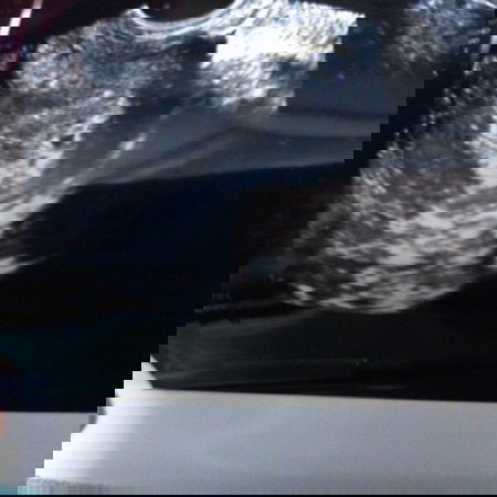 5week
แบบนี้ตั้งครรภ์ในมดลูกรึเปล่าค่ะ
พอดีเคยท้องนอกมดลูก