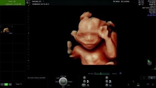 Em bầu bé đầu tiên 20tuân tuổi di siêu âm xương đùi bé dài 31mm liệu đã đạt tiêu chuẩn chưa ạ