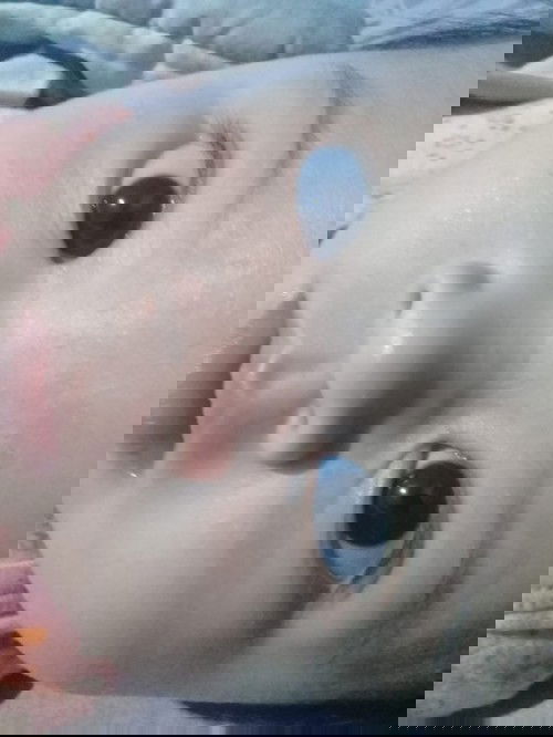 bruntusan di area wajah