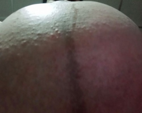 ขึ้นผื่นคันที่ท้องคันมาก