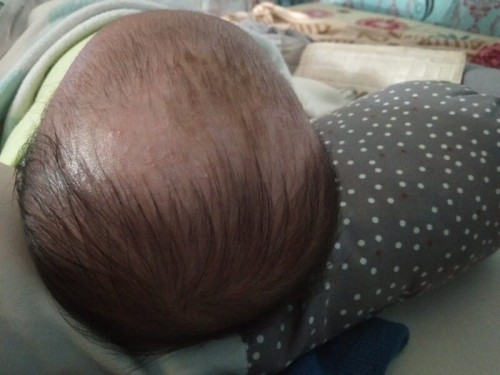 Rambut baby rontok