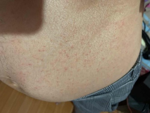 แสบมาก คันมาก แบบนี้เป็นไรมั้ยค่ะ มีแม่ๆบ้านไหนเป็นแบบนี้มั้ยค่ะ