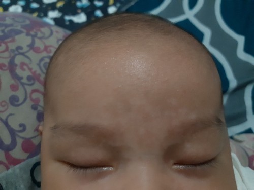 Bercak.putih diwajah bayi