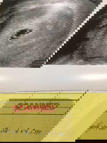 กังวลภาวะท้องลมค่ะ