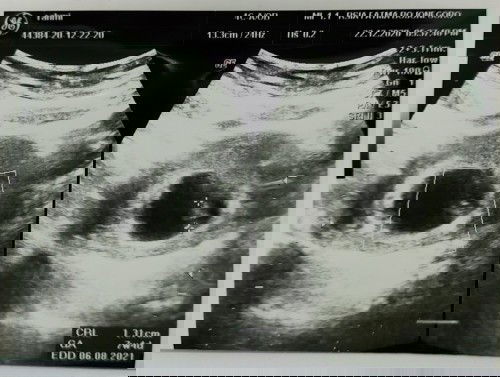 Beda usia USG dan HPHT