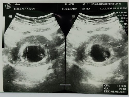 Beda usia USG dan HPHT