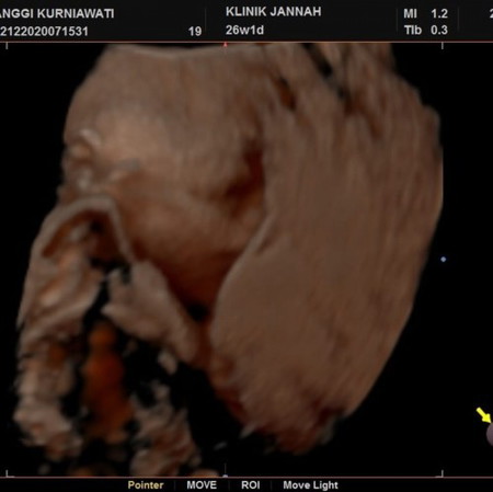 Pregnant 26 week 1 day