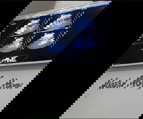 Stillbirth (bayi meninggal dalam kandungan) IUFD di kehamilan pertama #ibujuara