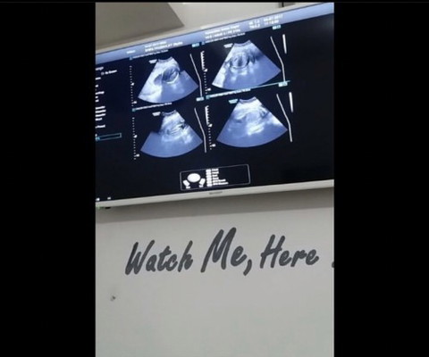 Stillbirth (bayi meninggal dalam kandungan) IUFD di kehamilan pertama #ibujuara