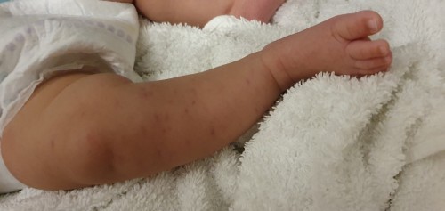 Rashes after 5-in-1 Vaccine for 3 mth old baby