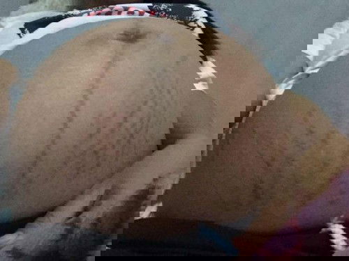 พอคลอดน้องแล้วท้องจะหายแตกไหมคะ