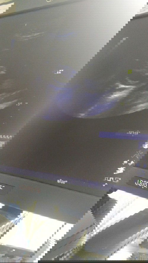 มีเลือดซึมในรก