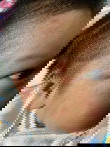 ผดผื่นหรือสิวทารก ค่ะ