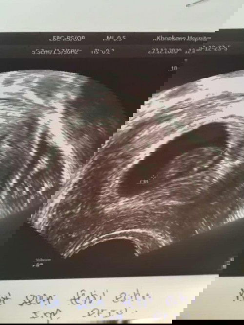 แท้ง3ครั้ง มีโอกาสมีลูกอีกได้ไหม