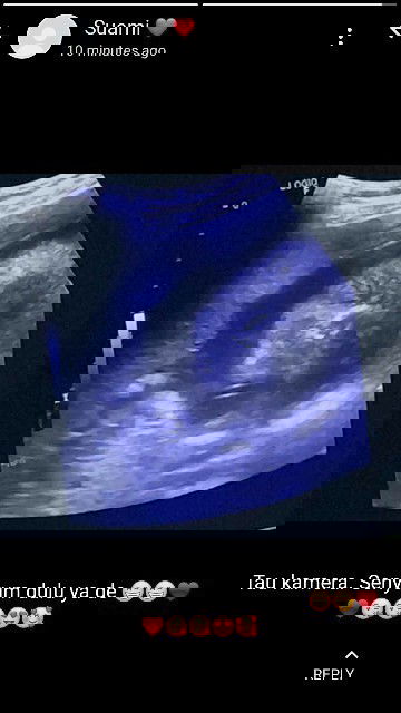 Kontraksi USIA 26 week